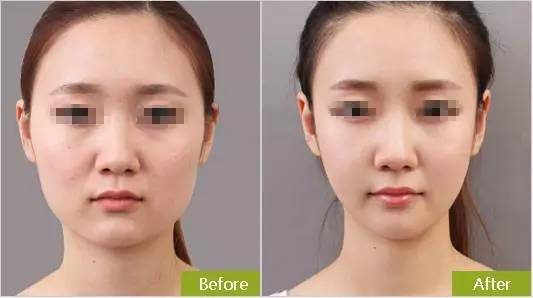 哪种脸型不能打瘦脸针,哪些脸型不适合打瘦脸针