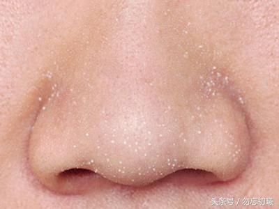 面部白头闭口粉刺怎么去除,最严重的粉刺消除方法