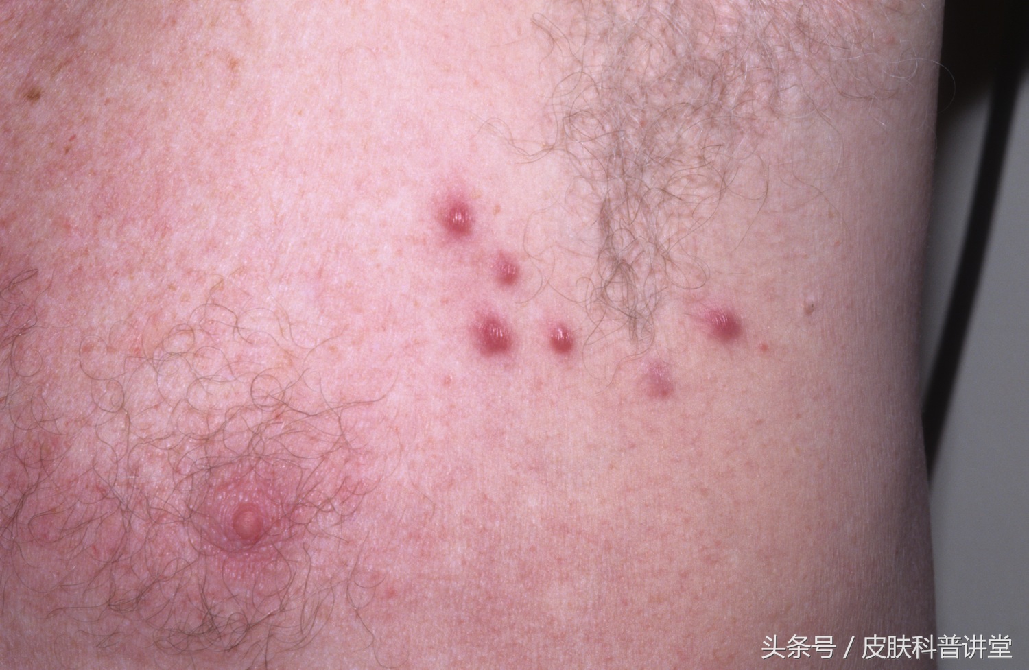 皮肤科普健康知识讲座,皮肤病种类图毛囊炎
