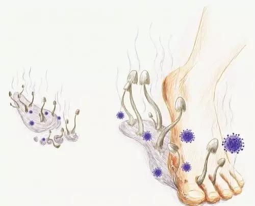 香港脚是谁传染给你的？