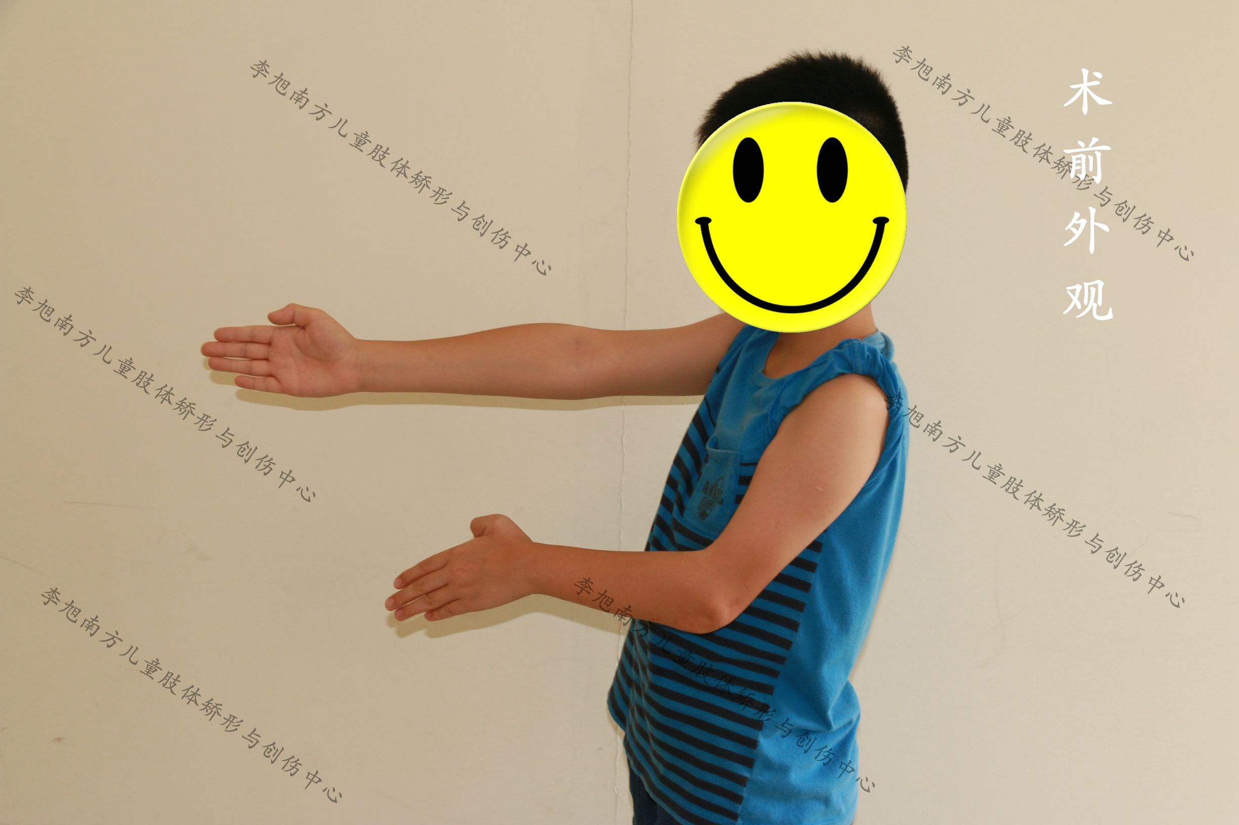 孩子胳膊摔伤后伸不直怎么办,小孩摔了跤胳膊伸不直是怎么回事