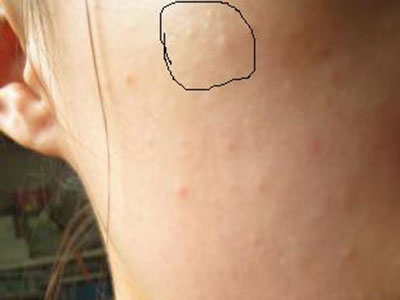 闭口粉刺痘痘怎么可以有效的去除,脸上长闭口粉刺最有效的去除方法