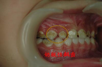 小洞不补大洞难补什么意思,5岁男童龋齿一个小洞处理办法