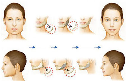 瘦脸针真的可怕吗,瘦脸针瘦腿针是什么原理