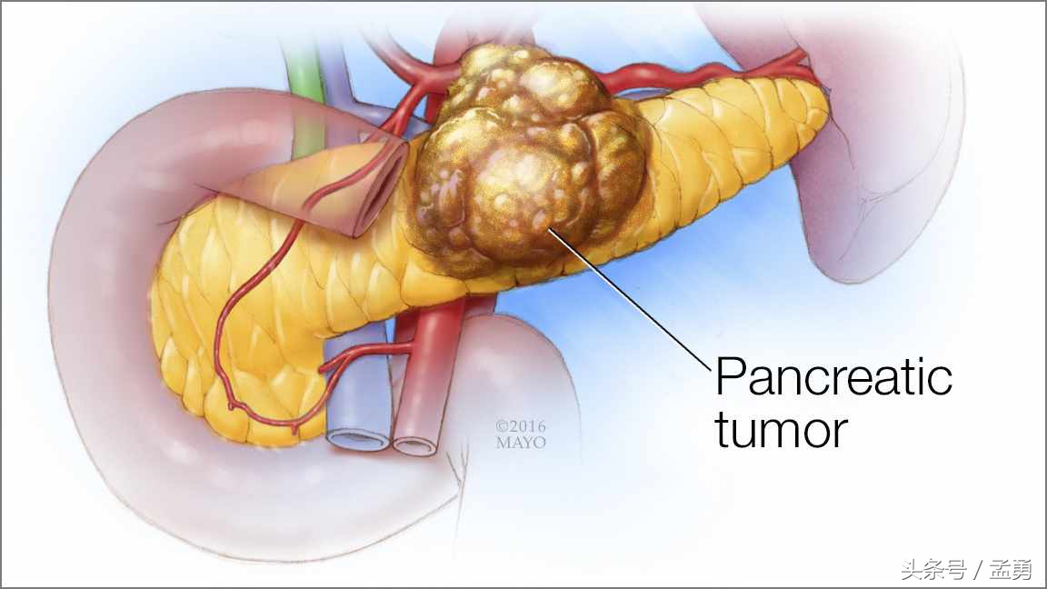 ca199升高怎么治疗,ca19937.3偏高吗