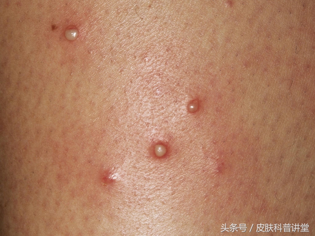 皮肤科普健康知识讲座,皮肤病种类图毛囊炎