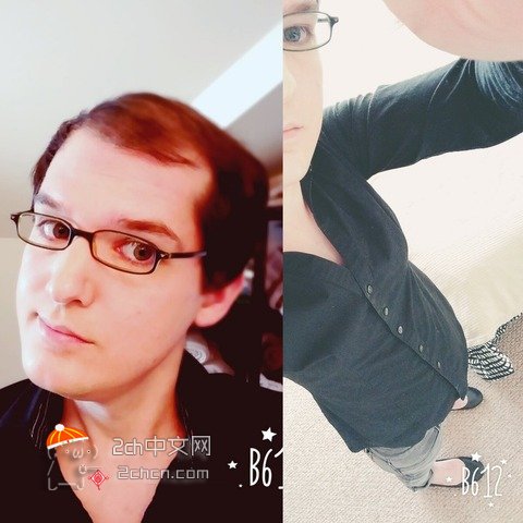 秃头大叔服用雌性激素,秃头男吃雌激素一年