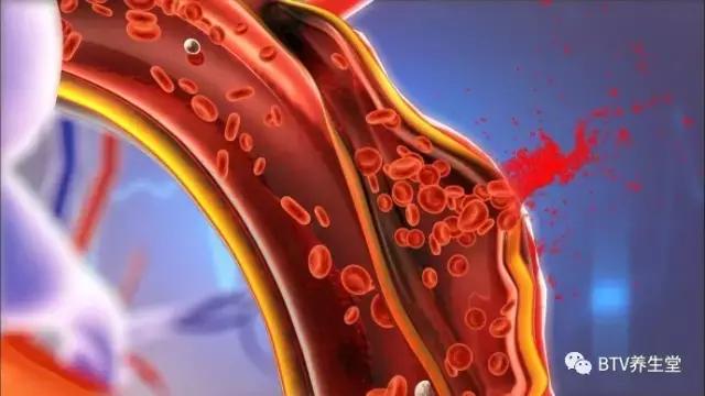 主动脉夹层破裂胸痛一般怎样治疗,主动脉夹层破裂后装支架的后遗症