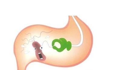 肠胃溃疡总是复发,十二指肠溃疡久治不愈会恶化吗