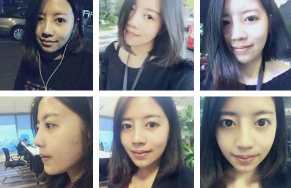 隆鼻后鼻子歪了如何手法矫正,硅胶隆鼻有点歪修复需要再付费吗