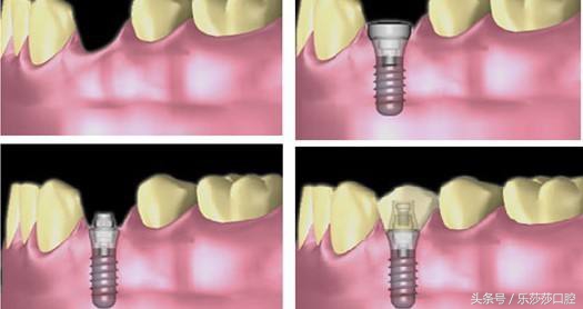 镶牙真的是一种错误吗,镶牙很假吗