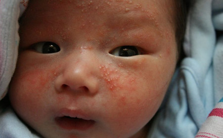 治湿疹糖皮质激素,治湿疹要调理脾胃吗