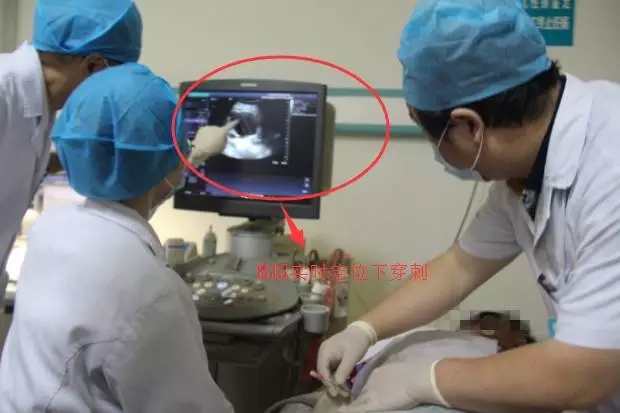 巨大肝囊肿怎么治疗杭州,巨大肝囊肿病例