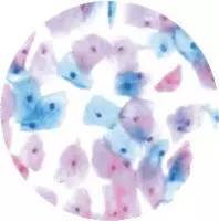 「推荐」读完此文,就会看宫颈癌筛查报告单了