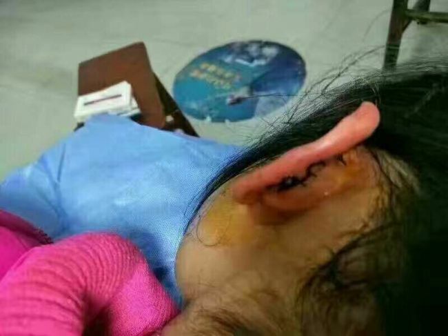 女孩作业未完成被老师杖责,女童因未完成作业被老师殴打住院