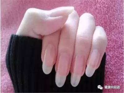 涨姿势一招让你辨别是不是肩周炎,各种类型的灰指甲