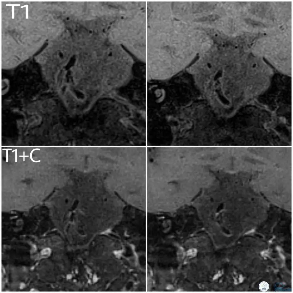 天坛医院基底动脉,天坛医院脑血管支架费用高吗