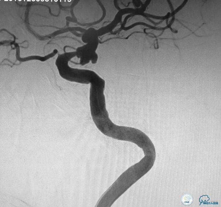 支架辅助弹簧圈栓塞治疗狭窄伴复杂动脉瘤