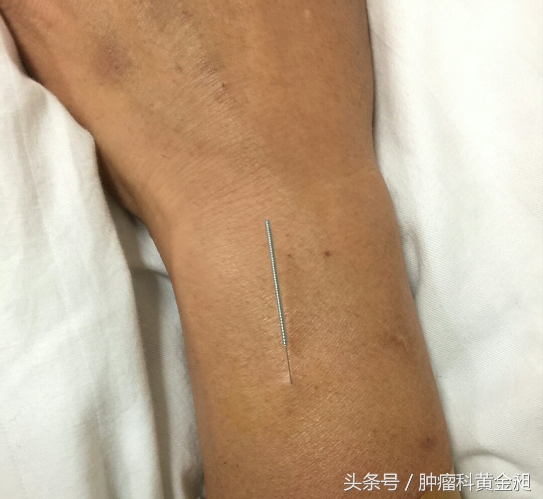 肝癌介入栓塞化疗的副作用,肿瘤介入手术栓塞血管