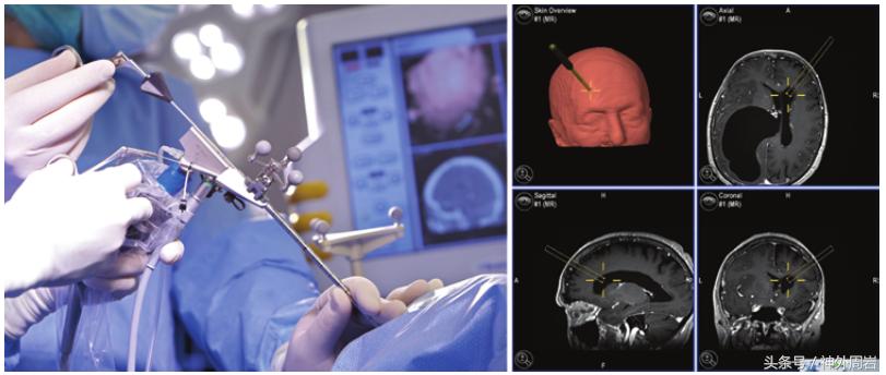 颅内蛛网膜囊肿有症状不及时治疗,颅内多发蛛网膜囊肿怎么治