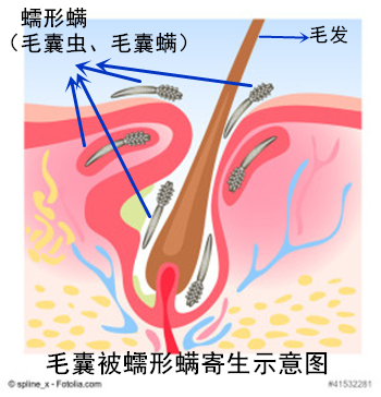 黑头粉刺也是虫吗,挤黑头粉刺毛孔里面像虫一样很长