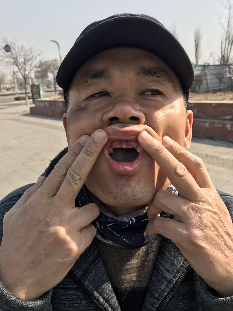 唐山老大哥骑车栽进无盖井，磕掉四颗门牙