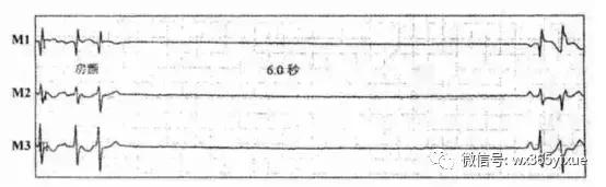 频发阵发性房颤需要怎么治疗好呢,房颤合并室速的治疗方案