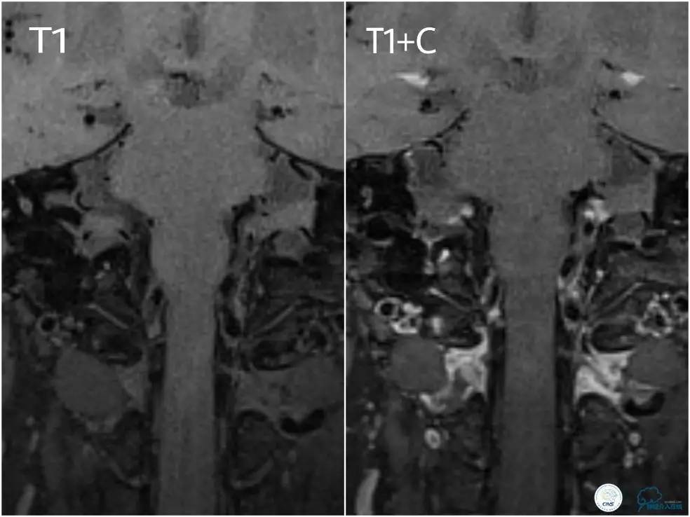 天坛椎动脉狭窄,天坛周记