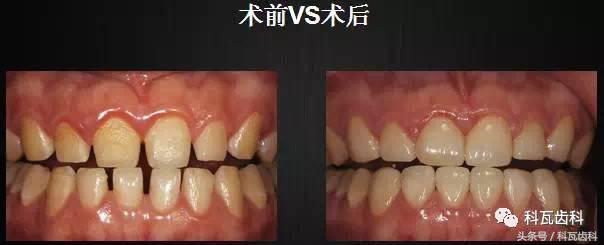 门下门牙有缝隙怎么补救,门牙开缝怎么处理最好