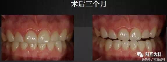 门牙旁边有缝最好的解决方法,门牙缝漏怎么补救