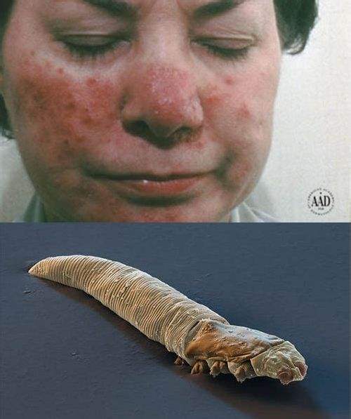 黑头粉刺也是虫吗,挤黑头粉刺毛孔里面像虫一样很长