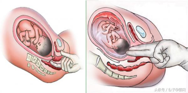 掌握自然分娩的四个产程要点，孩子顺产妥妥的！