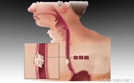 两种治食道癌单方治愈率百分之百,食道癌二味中药