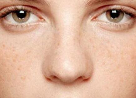 去除斑点最有效的方法,去除斑点的最有效方法