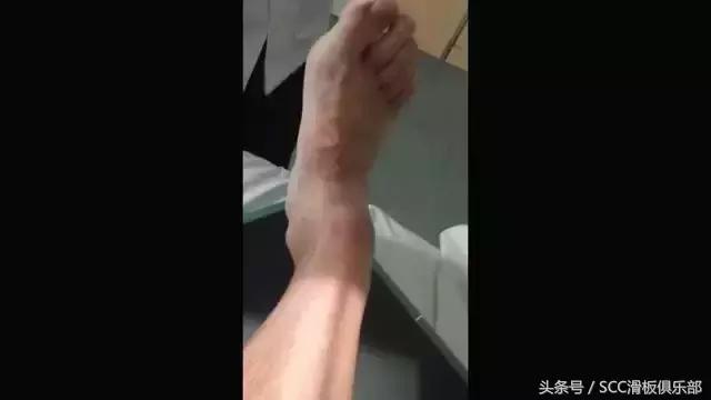 怎么快速恢复崴伤的脚踝,如何彻底治愈脚踝陈旧性扭伤
