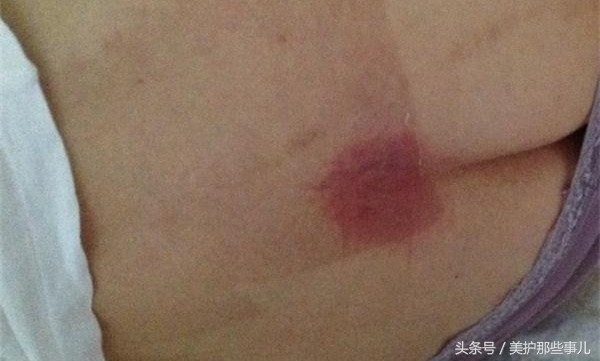 褥疮用碘伏消毒后可以用紫药水吗,老年人的褥疮能用碘酒消毒吗