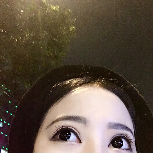 全切双眼皮疤痕增生多久可以恢复,全切双眼皮恢复过程经历真实