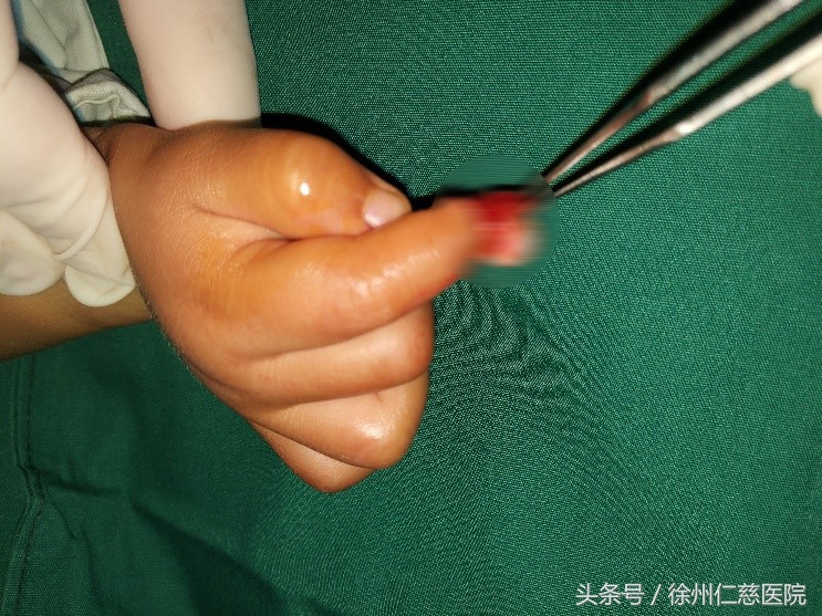 萌宠?杀器?3天内徐州仁慈医院连接2例被宠物咬伤幼童