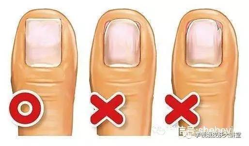 嵌甲自己剪出来就好了吗,嵌甲能修脚吗