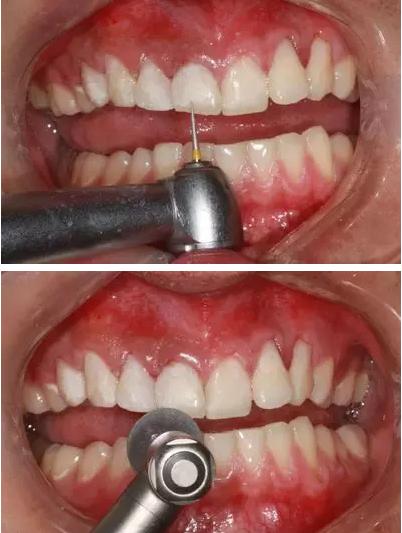 目前补救可乐牙最好的办法,可乐牙的治疗贵么