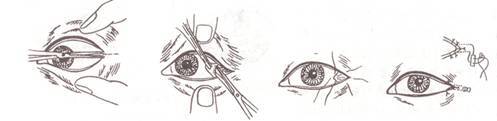 内眼角去哪里开,内眼角怎么开眼角