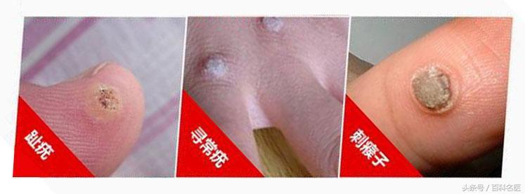 人乳头瘤病毒为何如此猖狂？与宫颈癌、尖锐湿疣等有怎样的纠葛？