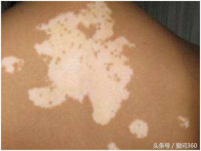 白癜风每月打一针预防扩散管用吗,怎么预防白癜风不扩散