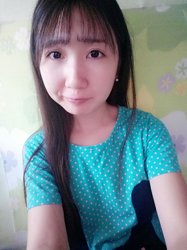 双眼皮全切手术恢复期,全切双眼皮恢复期眼尾分叉正常吗