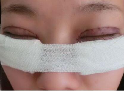 完美的埋线双眼皮,完美双眼皮