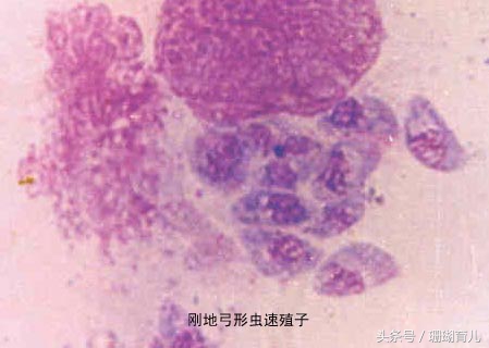 小孩染上弓形虫症状跟体质有关吗,5岁小孩感染弓形虫病严重吗