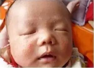 春风一吹身上起小疙瘩,春风吹的脸上起小疙瘩