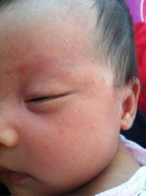 如何根治宝宝反复发作的湿疹问题,宝宝得了湿疹的最佳治疗方法