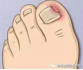 大脚趾甲有点轻微的嵌甲怎么处理,嵌甲手术后指甲还能恢复原样吗