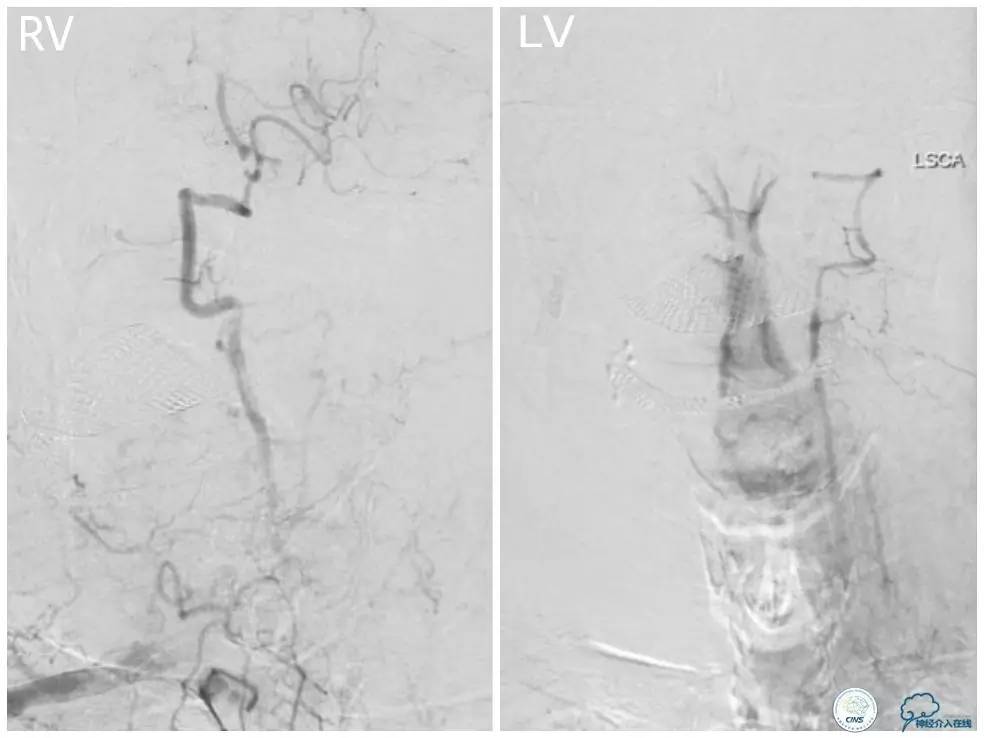 天坛周记|右椎动脉V1段及V4-基底动脉串联病变支架治疗一例